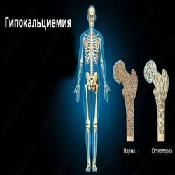 Гипокальциемия препараты купить, профилактика, симптомы гипокальциемия