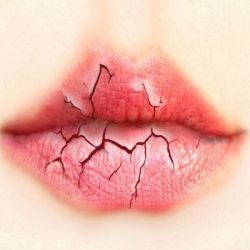 Хейлит препараты купить, профилактика, симптомы хейлита
