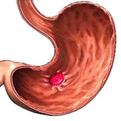 Поліпоз шлунка і кишечника